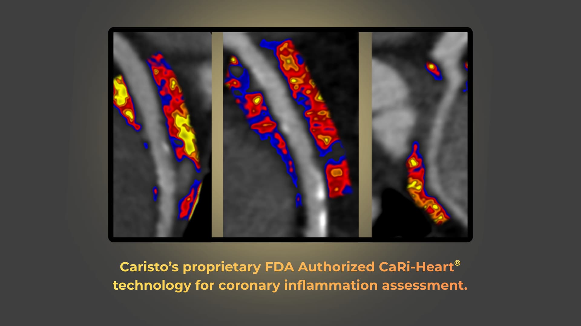 AI Detects Hidden Heart Attack Risk in Half of Patients Traditional Scans Miss