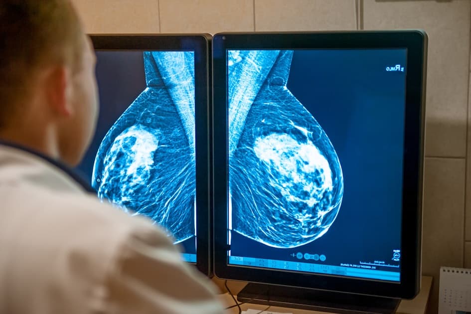 Dense Breasts Expose Critical Blind Spot in AI Mammography Systems