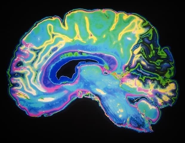 Brain Implant Reads Neural Conversations to Treat Depression and PTSD