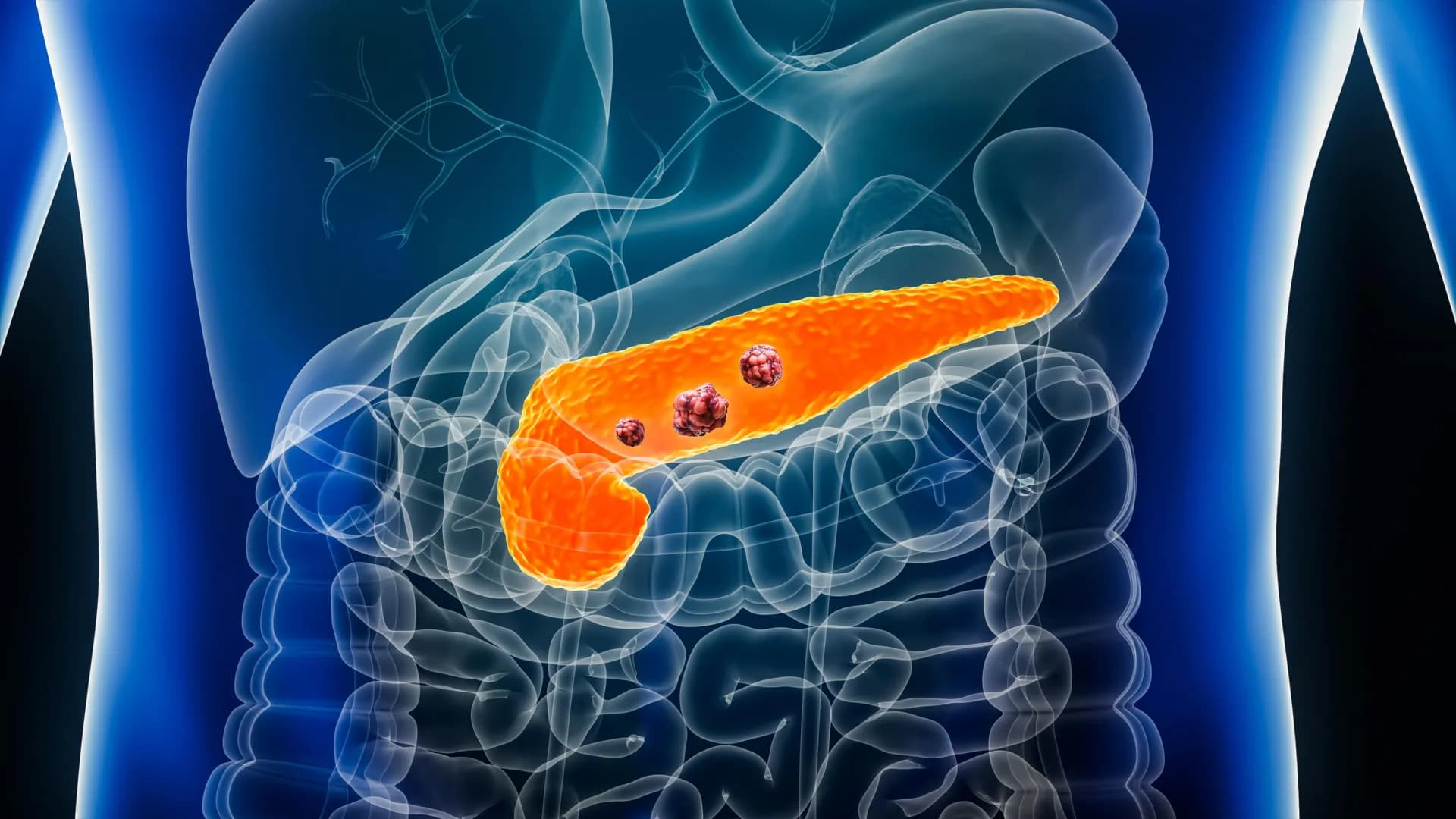 Machine Learning Spots Pancreatic Cancer 16 Months Before Radiologists Can See It
